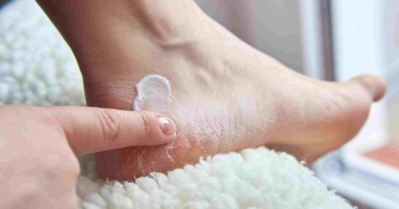 Best Home Remedy for Dry and Cracked Feet : Get Soft Heels This Winter